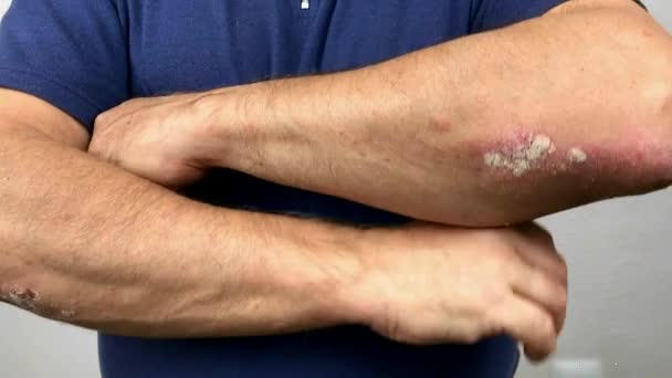 Dedos de un anciano con psoriasis y eczema. Un primer plano de la peladura de la piel — Vídeos de Stock