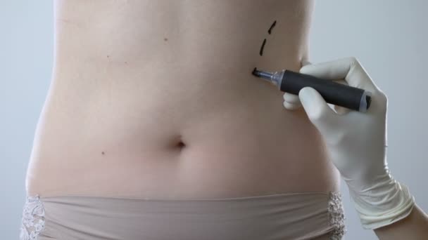Рисунки хирурга на брюшной полости, подготовка женщины к операции по липосакции — стоковое видео