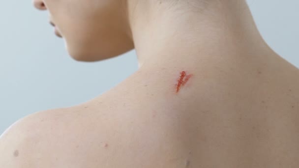 Trabalhador do hospital examinando ferida nas costas sob lupa, risco de infecção — Vídeo de Stock