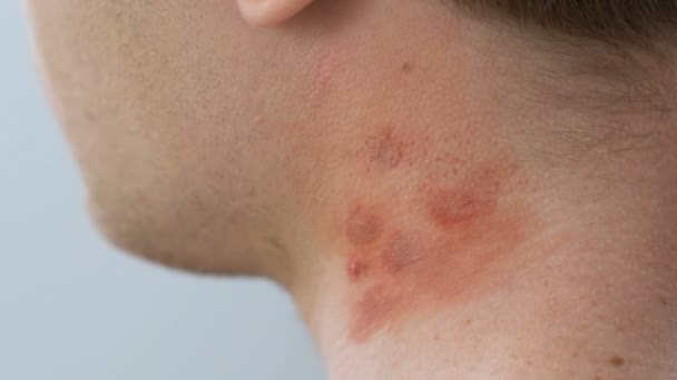 Dermatologist examining neck rashes with magnifying glass, allergy reaction — Stock Video