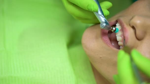 Dentista profesional blanqueamiento de dientes de mujer joven, cuidado dental, primer plano — Vídeos de Stock