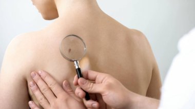 Köstebek Büyüteç, cilt kanseri önleme aracılığıyla kontrol dermatolog