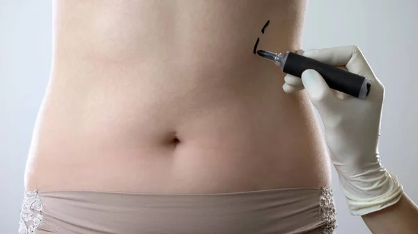 Surgeon Drawing Marks Female Abdomen Preparing Patient Plastic Surgery — Stock Photo, Image