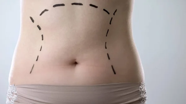 Female abdomen with marks drawn on skin, plastic surgery, beauty standards
