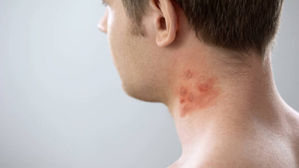 Red spots on male patient neck, bites of insects, allergy, contact dermatitis