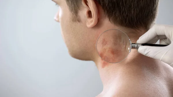 Therapeut Onderzoekt Uitslag Nek Van Patiënt Met Vergrootglas Dermatologie — Stockfoto