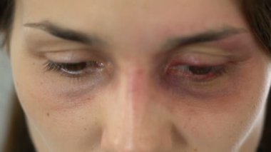 Yaralı yüz arıyorum kamera, dur zorbalık, şiddet utanç kadınla