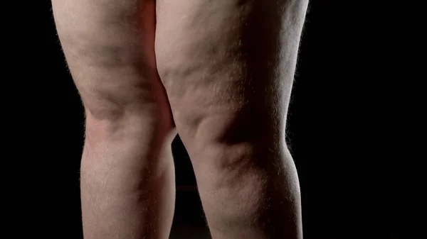 Cellulite Gambe Maschili Con Smagliature Disturbi Ormonali Cura Della Pelle — Foto Stock