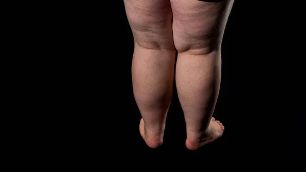 肥胖男性腿与下垂的皮肤和脂肪团 过量食物摄取健康护理 — 图库照片