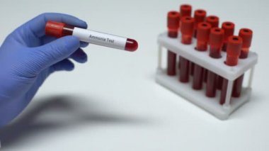 Amonyak testi, tüp, laboratuvar araştırma, sağlık muayenesi doktor gösteren kan örneğinde