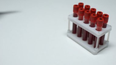 Pozitif fosfor test, Doktor gösteren kan örneği tüp, laboratuvar araştırma