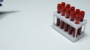 Pozitif çiçek hastalığı testi, Doktor gösteren kan örneği tüp, sağlık check-up