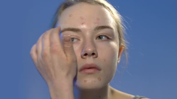 Junge Frau mit Pickelhaut, die Foundation Creme aufträgt, der Wunsch schön zu sein — Stockvideo