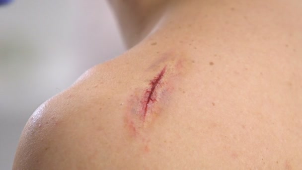 Nurse applying adhesive bandage on scratched shoulder, knife wound, close-up — Stock Video