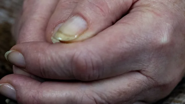 Old Female Hands Closeup Aged Wrinkled Skin Pension Poverty Senior — Stock Photo, Image