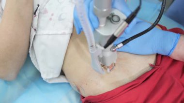 Erkek cerrah doktor, kozmetik kliniğinde lazerle karın bölgesindeki yarayı öğütüyor..