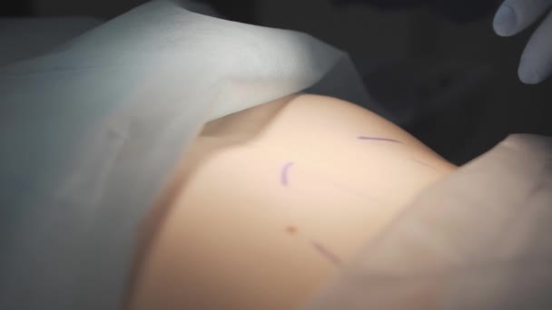 Cerrah doktor neşteri alır ve karın bölgesinde daha fazla liposuction için bir kesik hazırlar.. — Stok video