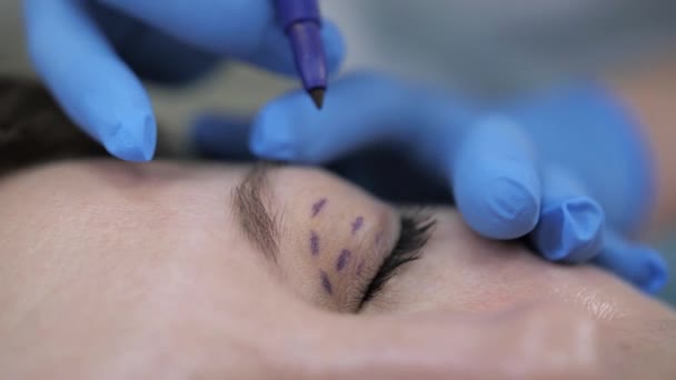 Blepharoplastik, ein Chirurg macht Markierungen auf den Augenlidern für weitere Operationen. — Stockvideo