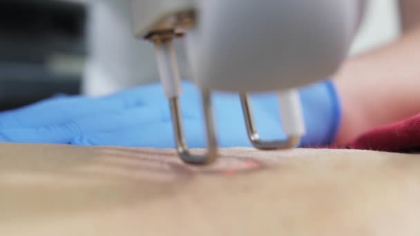 Um médico cirurgião esmaga uma cicatriz na sala de cirurgia com um laser em uma clínica de cosmetologia . — Vídeo de Stock