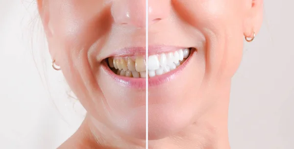Concept of before and after teeth cleaning and whitening treatme