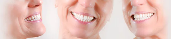 Conjunto de tres vistas de dentición natural de mujer caucásica — Foto de Stock