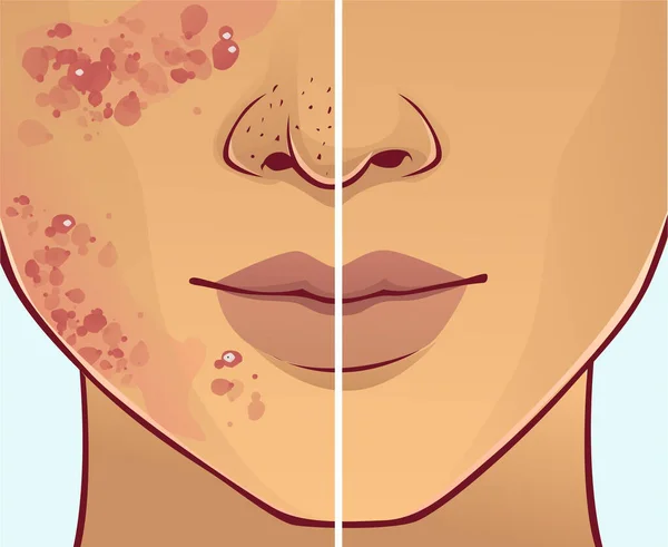 Face Skin Problems Vector Illustration — Stock Vector