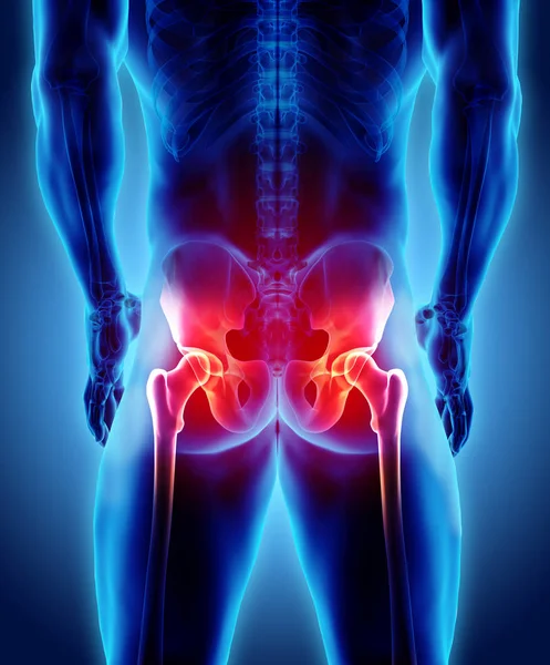 Ilustracja Hip Bolesne Szkielet Ray Medyczną Koncepcję — Zdjęcie stockowe