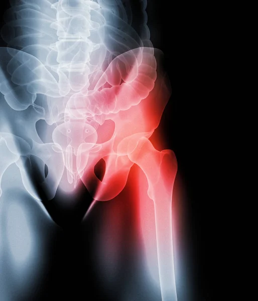 Ilustración Radiografía Esqueleto Doloroso Cadera Concepto Médico —  Fotos de Stock