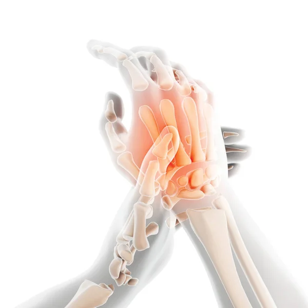 Ilustracja Palm Bolesne Szkielet Ray Medyczną Koncepcję — Zdjęcie stockowe
