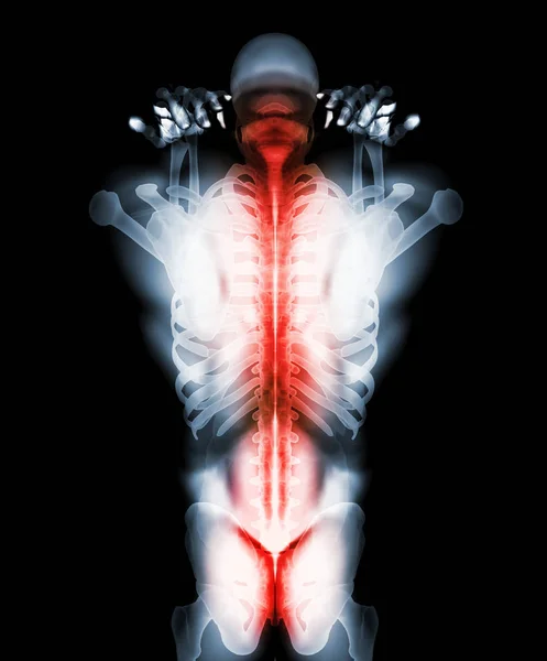 3D Illustration of sacral and cervical painful, medical concept.