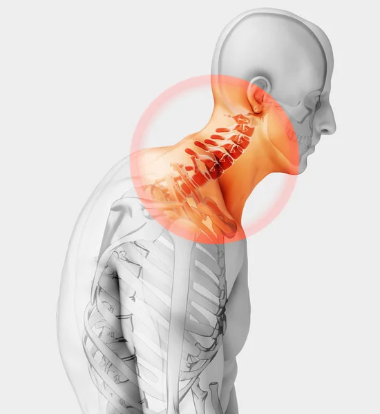 Ілюстрація Шия Болюча Рентген Шийного Хребта Медична Концепція — стокове фото
