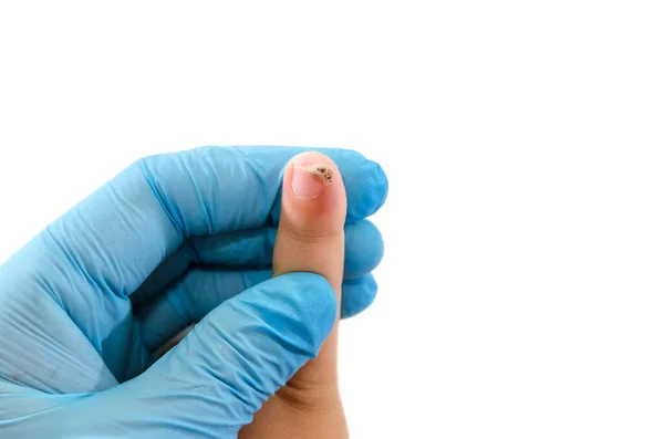 Mano Del Médico Guante Azul Sostiene Mano Niño Con Dedo — Foto de Stock