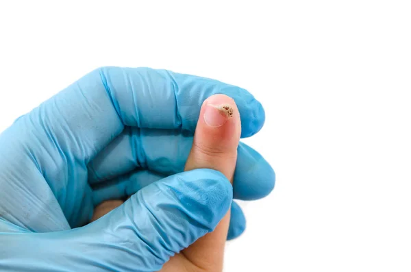 青い手袋の医者の手は痛みを伴う指で子供の手を保持します 子供の指の上の傷や乳頭 — ストック写真