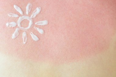 Sahilde güneş yanığı üstüne kırmızı yanıklı bir kadın derisi.