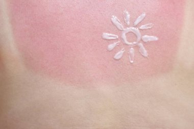 Güneş yanığı olan bir kızın sırtında güneş kremi.