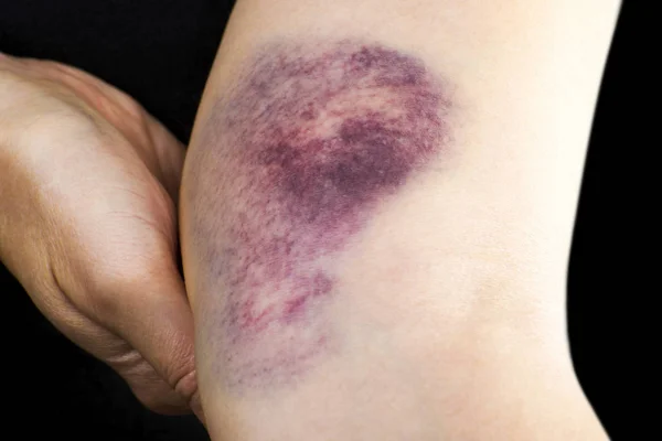 Hematoma en brazo de mujer — Foto de Stock