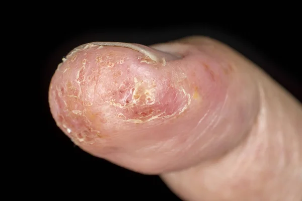 Eczema no polegar masculino — Fotografia de Stock