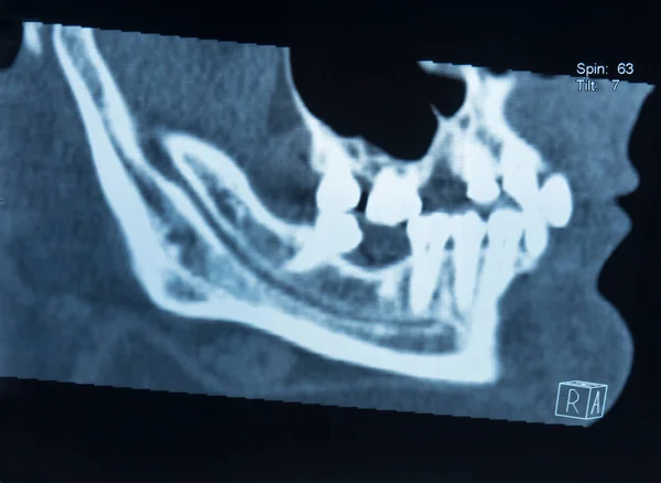 Image Radiographique Mâchoire Femelle Homme Sans Plusieurs Dents Vue Côté — Photo