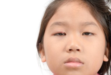 Close up of asian little girl one eye infection isolated on white background, eyelid abscess, stye, hordeolum. Concept of health, disease clipart