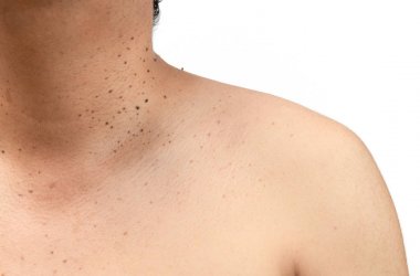 Closed up the skin tags or Seborrheic Keratosis on neck  clipart