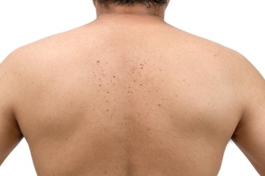 skin tags or Seborrheic Keratosis on back  clipart