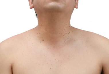 Closed up the skin tags or Seborrheic Keratosis on neck  clipart