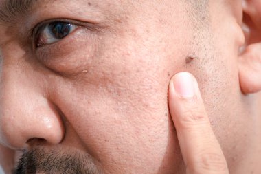 Closed up of big skin tags or Acrochordon on face middle-aged asian man , Health care concept clipart