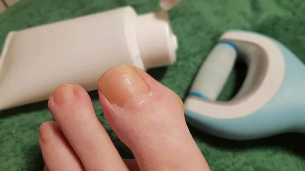 Bir parmak bir nasır tedavisi