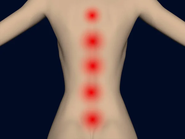 Realistische vrouwelijke rug met rode plekken langs de wervelkolom. Punten van pijn in de rug. 3D. vector illustratie — Stockvector