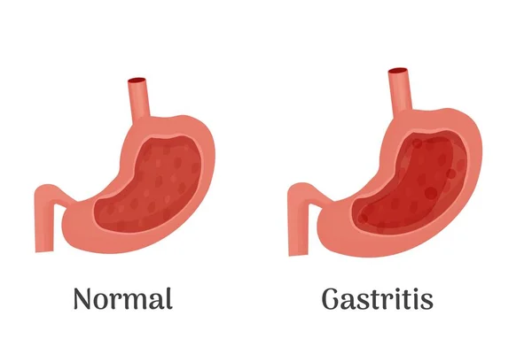 Anatomia dello stomaco sano e malsano umano, poster medico con un diagramma dettagliato della struttura dall'interno dello stomaco, malattie del sistema digestivo - normale e gastrite — Vettoriale Stock