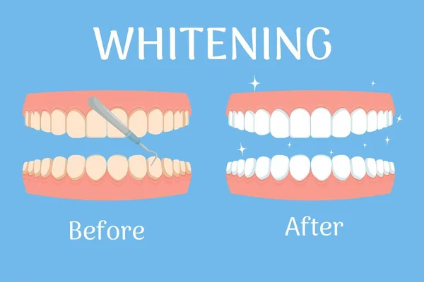 前と後の歯を白く 口内炎 歯の概念は隔離されました ヘルスケアと美容の在庫 ベクターイラスト — ストックベクタ