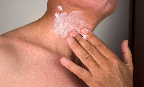 Boynunda güneş kremi olan bir adam.