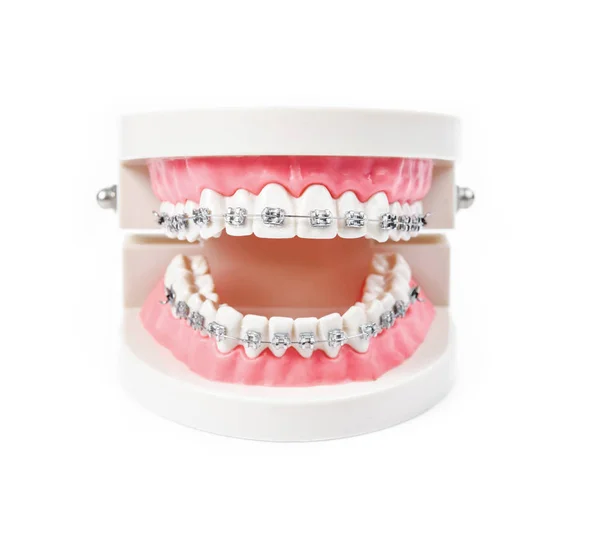 Tooth Model Metal Wire Dental Braces Isolated White Background — Stock Photo, Image