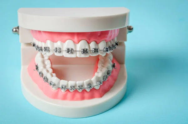 Model Zęba Drutu Ortodontycznych Niebieskim Tle — Zdjęcie stockowe
